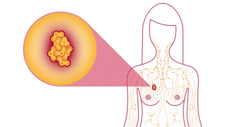 " دور انتشار IVIM في تشخيص سرطان الثدي " م.د مهند احمد صاحب