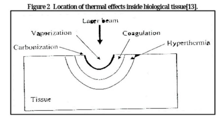 التأثير السلبي لأشعة الليزر على لزوجة الدم في جسم الإنسان بقلم ا.د رعد شاكر النايلي
