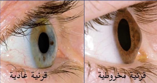 مقالة علمية للدكتور أمير محمد هادي موسى بعنوان (أحدث طرق علاج القرنية المخروطية)