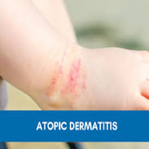 Overview of Atopic Dermatitis
