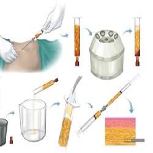 Nanofat: A Natural Approach to Facial Rejuvenation