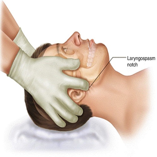 Laryngeal spasm post extubation