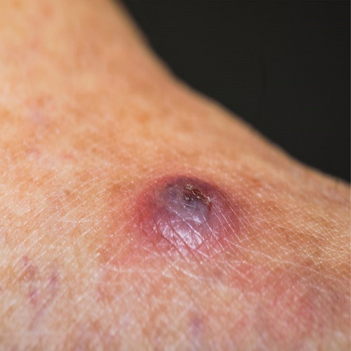 داء الليشمانيات