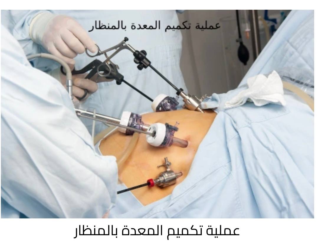 حلقة نقاشية "عملية تكميم المعدة بالمنظار"