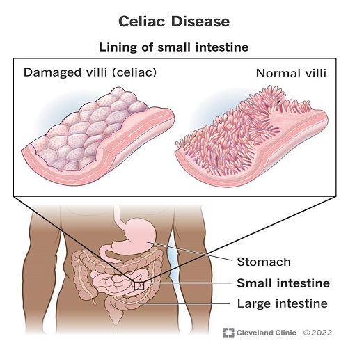 Celiac disease