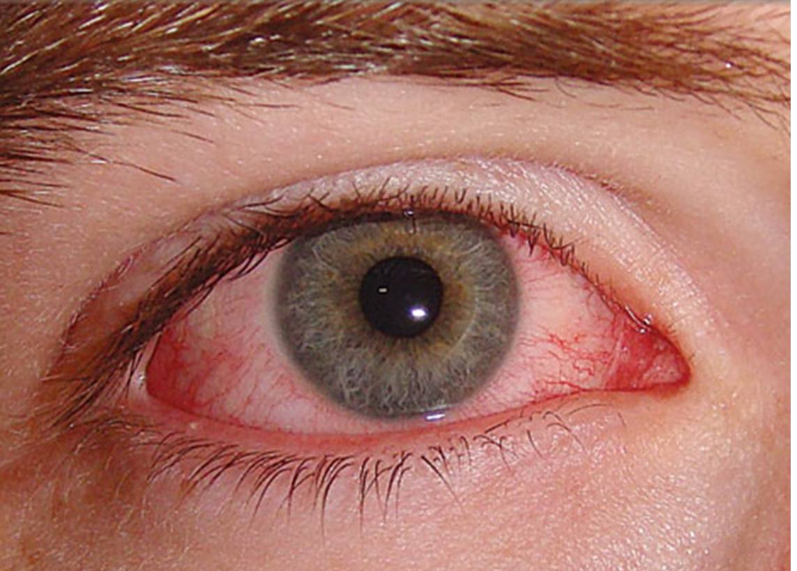 مقالة علمية لمعيدة تمارا نهاد عباس بعنوان (تأثير درجة الحرارة على ضغط العين).