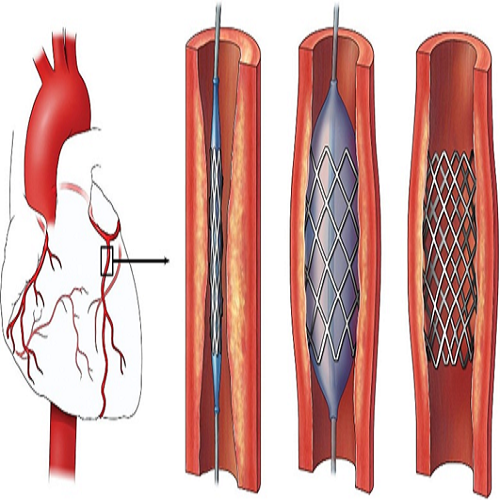 Safety of Ramadan Fasting for patient with Percutaneous Coronary Intervention