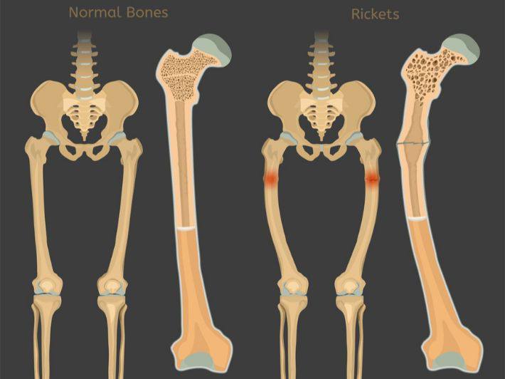 An article about rickets by lecturer Elaf Ali Obaid
