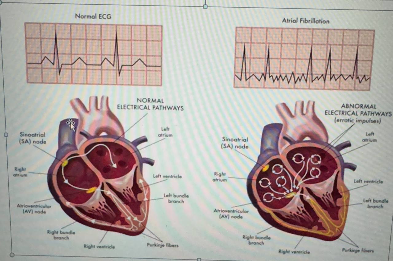 A scientific article by the teacher, Mrs. Zahraa Raad Abdel Hakim by Atrial Fibrillation.