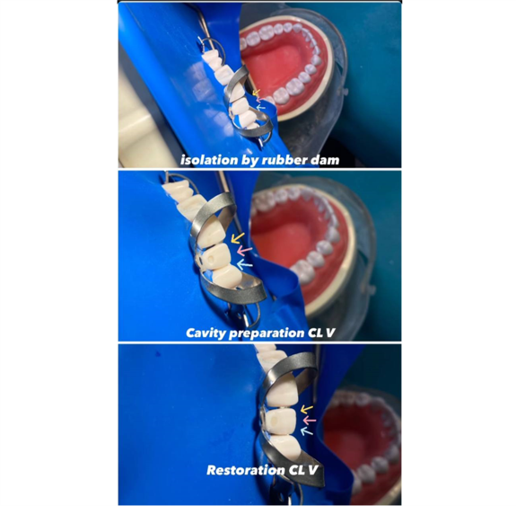 ابداع الطالبة مينا مجيد في عمل حشوات تجميلية داخل مختبر الفانتوم 