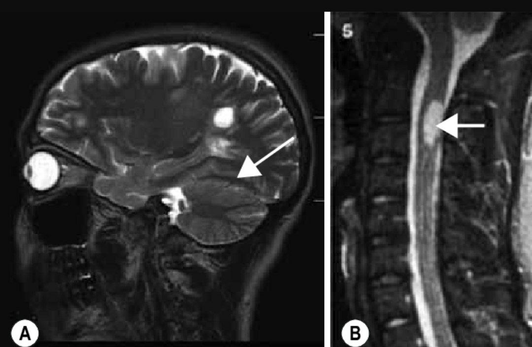Multiple Sclerosis |  Multiple Sclerosis (MS)
