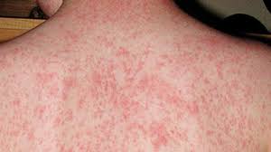 ماهي الحصبة