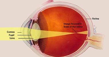 مقالة علمية بعنوان " الجوانب الوراثية لقصر البصر والاكتشافات الحديثة في هذا المجال " للست (نور فراس محمد رضا نجم)