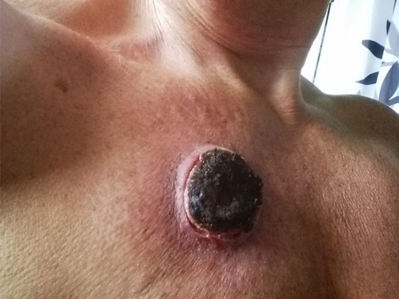 علاج السرطان