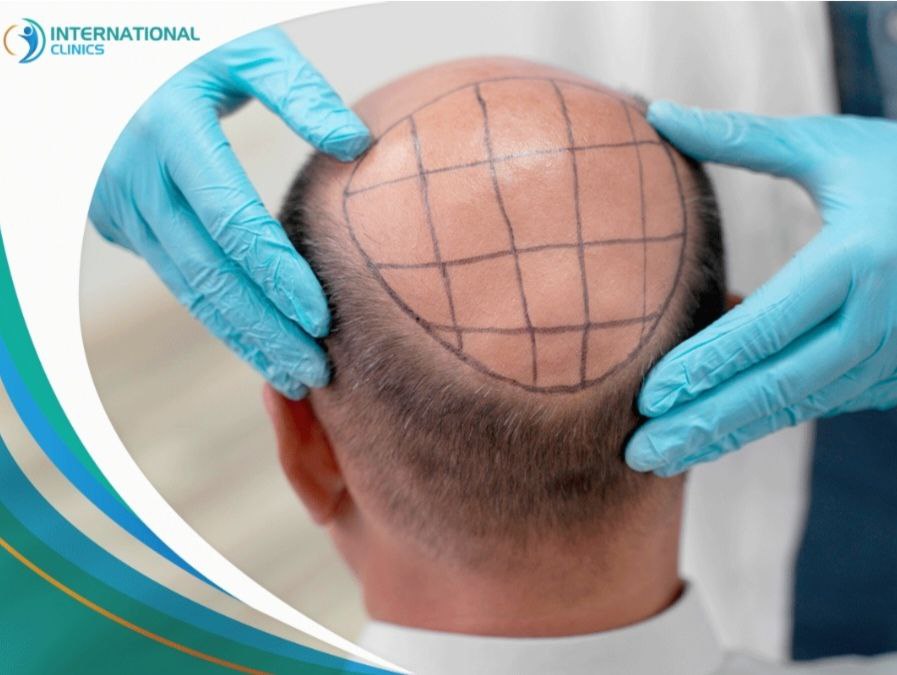 مقالة علمية بعنوان "زراعة الشعر" للطالبة (راوند مسلم حسن )–كلية العلوم– قسم علوم الفيزياء الطبية–المرحلة الثالثه– كروب i وباشراف (م.م علي جعفر عبيد)