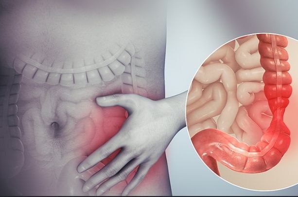 مقالة علمية بعنوان "انسداد الامعاء" للطالبة (ضي علاء جاسم) جامعة المستقبل-كلية العلوم-قسم علوم الفيزياء الطبية- المرحلة الثالثة_كروبJ وبأشراف (م .م علي جعفر عبيد)
