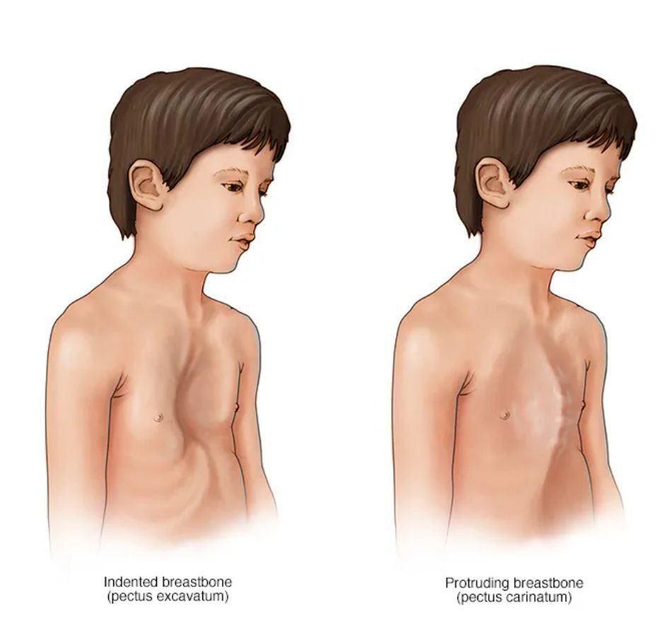 مقالة علمية بعنوان "متلازمة مارفان" للطالبة (زينب ارتفاق عايد) جامعة المستقبل-كلية العلوم-قسم علوم الفيزياء الطبية- المرحلة الثالثة_كروبC وبأشراف (م .م علي جعفر عبيد)