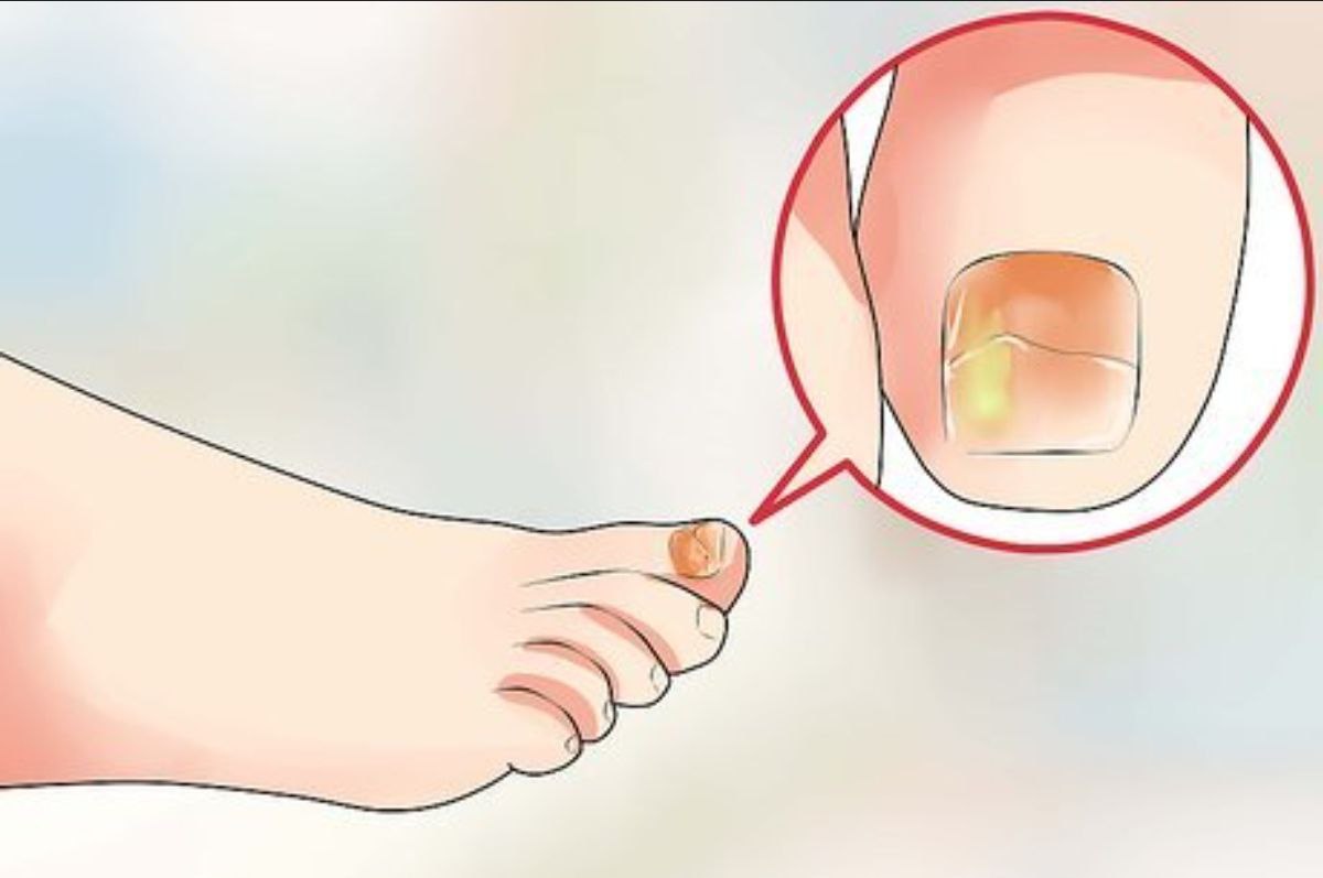 مقالة علمية بعنوان "القدم الرياضي" للطالبة (فرح فؤاد كاظم) جامعة المستقبل-كلية العلوم-قسم علوم الفيزياء الطبية- المرحلة الثانيه_كروبE وبأشراف (م . محمد جمال اسود)