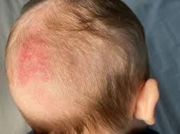 مقالة علمية للتدريسية (م.م زينب ناظم عزيز) بعنوان " سَعْفَةُ الرَّأْس"