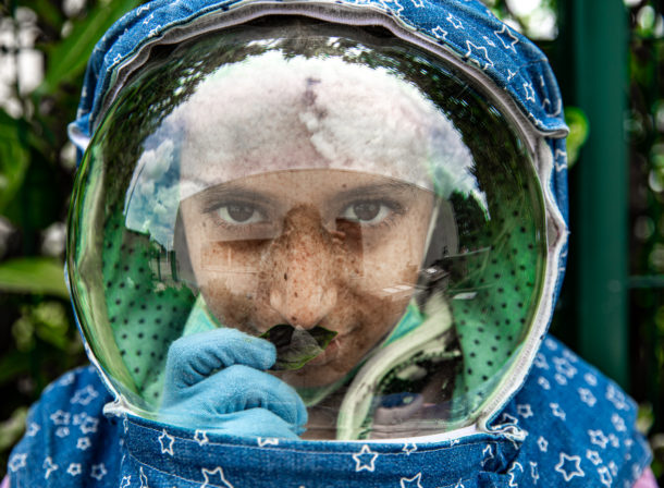 A Scientific Article  By Amna Majid Maki Entitled: [Xeroderma pigmentosum: children of the moon] 