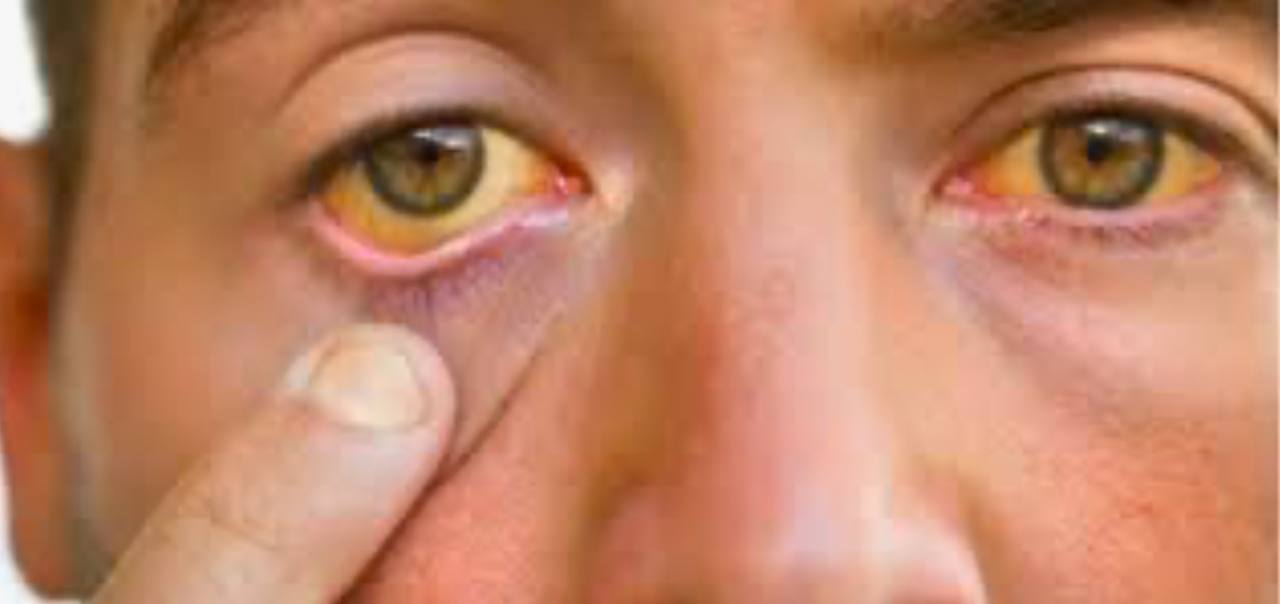 مقالة علمية للمعيدة (بنين معن كريم ) بعنوان "التهاب الكبد الفايروسي "