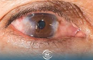 مقاله علمية ل( احمد جلال نعمة ) بعنوان "" الماء الابيض في العين ""