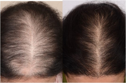 The Effect of Platelet-Rich Plasma (PRP) on Hair Quality: A Revolutionary Approach to Hair Restoration