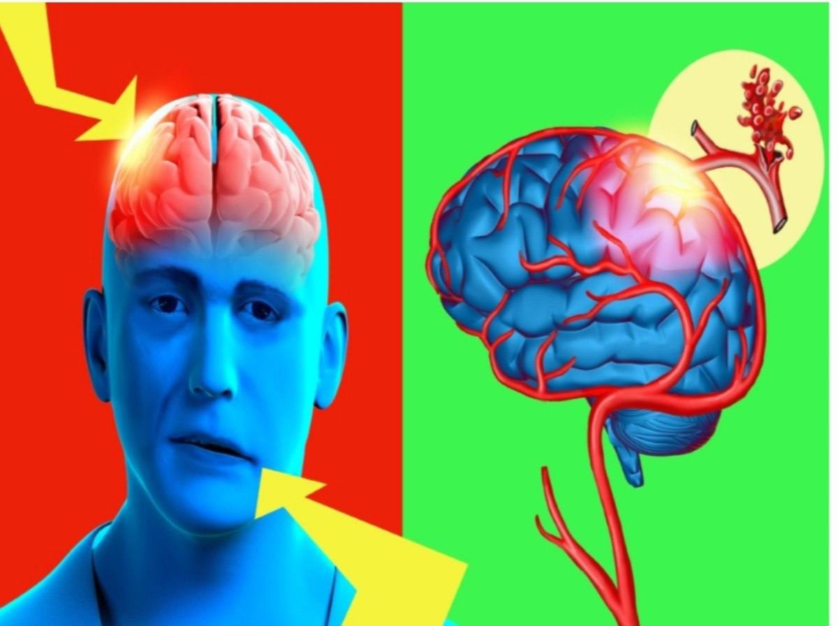 A scientific article entitled "Stroke" by the lecturer (Mr. Ali Jaafar Obaid).