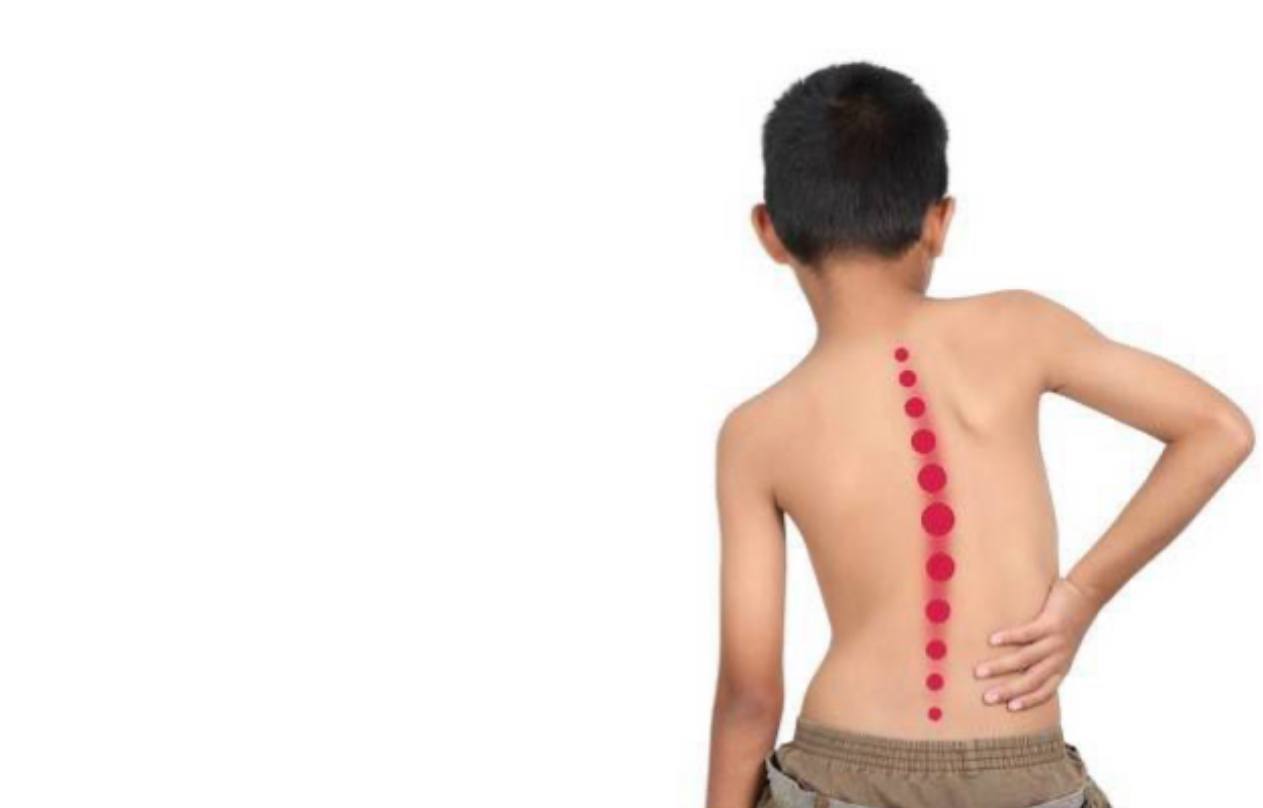 A scientific article by the teaching assistant (Maryam Latif Shandal) entitled “Scoliosis is a lateral curvature of the spine.”