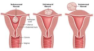 Relation between fibroid and infertility
