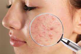 The PCOS and acne connection