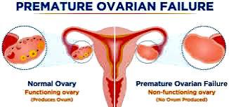 Premature Ovarian Failure: A Brief Overview