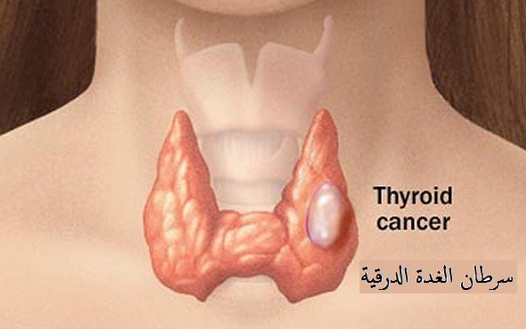 سرطان الغدة الدرقية