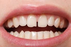 مقالة علمية بعنوان ( Diastema )