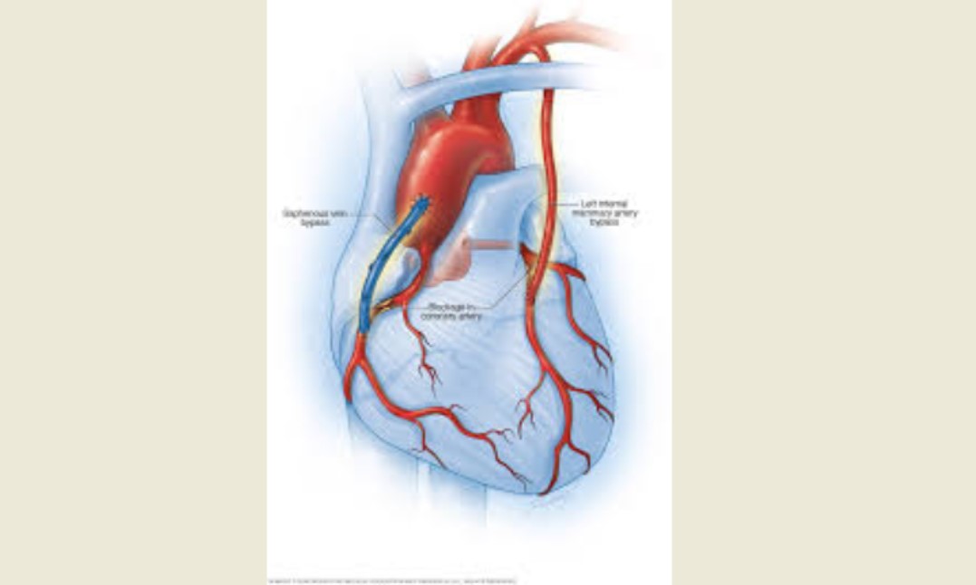 مقالة علمية للسيدة زهراء بدر محمد بعنوان مرض الشريان التاجي