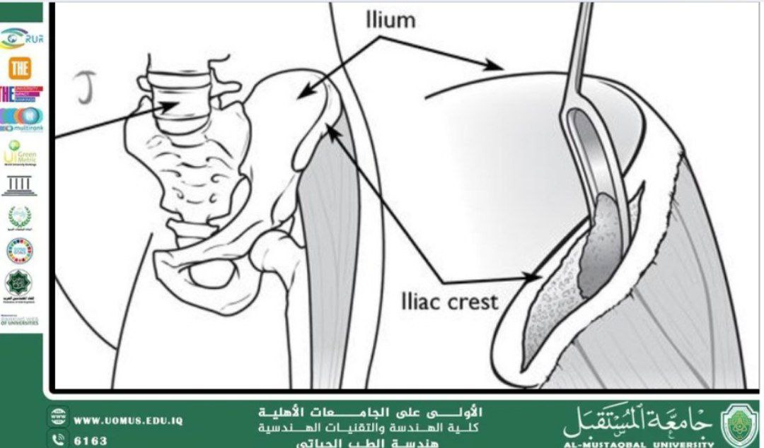 مقالة علمية بعنوان " What are bone implants" للمهندسة زهراء محمد كاظم