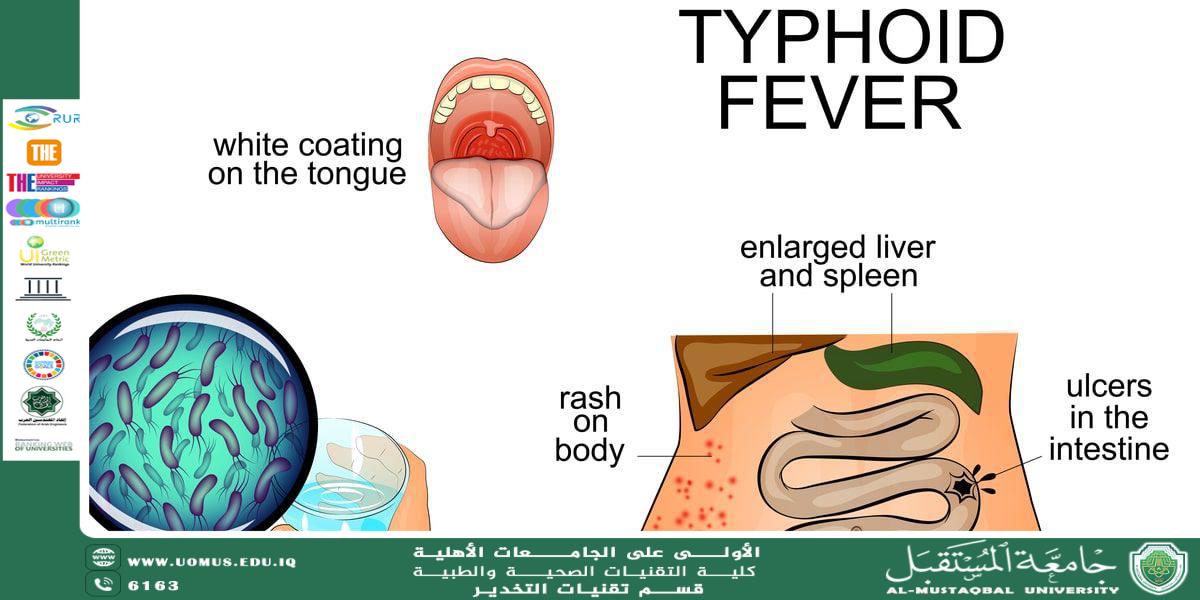 Typhoid fever, also called enteric fever, is caused by salmonella bacteria. Typhoid fever is rare in places where few people carry the bacteria.
