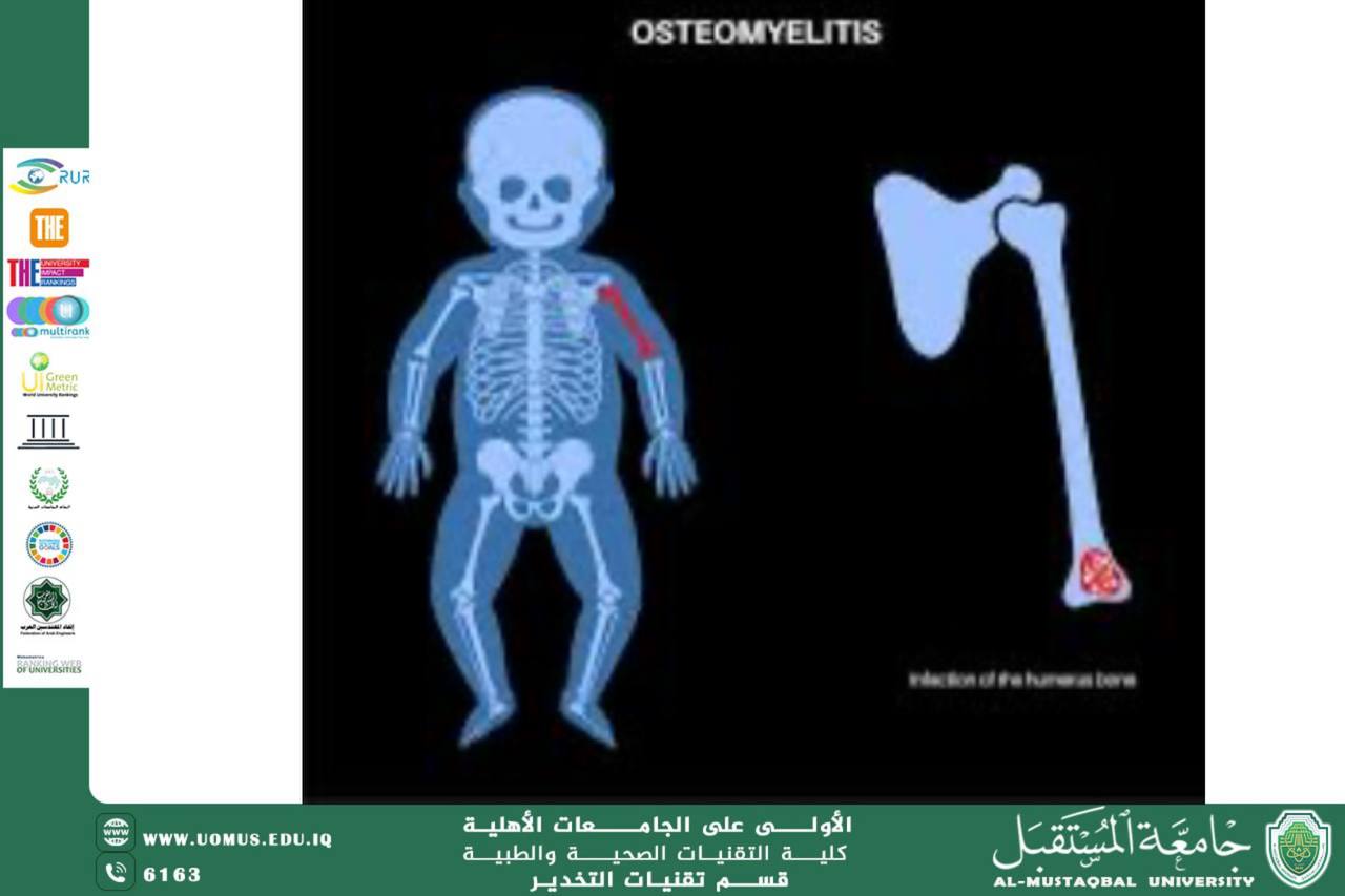 Osteomyelitis in children