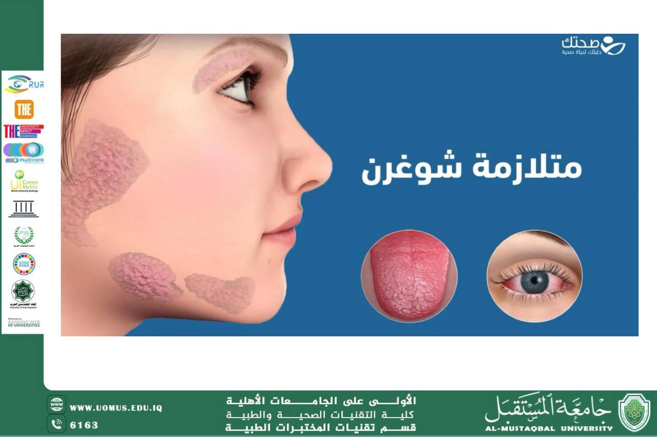 مقالة علمية للسيدة مريم نجاح هادي بعنوان متلازمة شوغرن