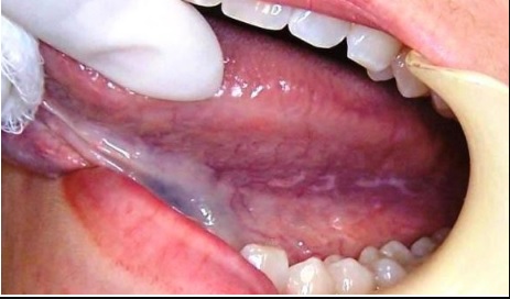 Oral Lichen Planus: A Chronic Inflammatory Condition by Ghadeer talib