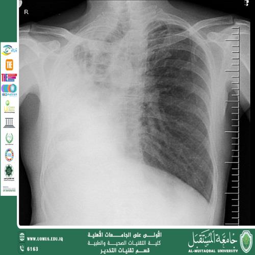 Lung Collapse Post-Intubation: Incidence and Prevention