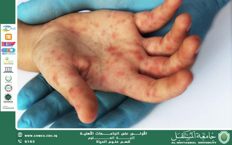 A scientific article by the lecturer (M.M. Zahraa Jawad kadhim) entitled "Foot-and-mouth disease"
