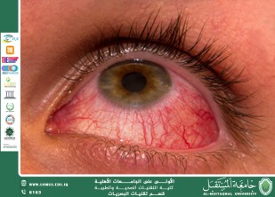 An article by the lecturer Nilofer Ali entitled(Allergic conjunctivitis)