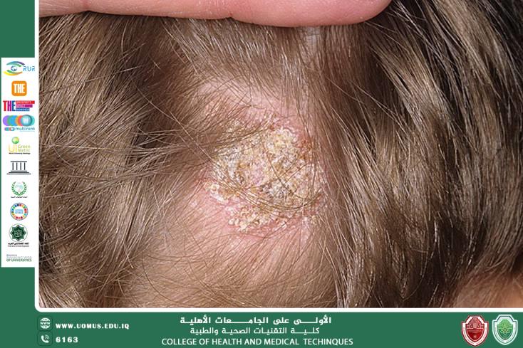 السعفة الجلدية