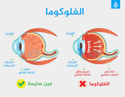مقالة علمية للتدريسي م.م.مهيمن سمير عارف بعنوان(ضغط العين المرتفع (الجلوكوما).