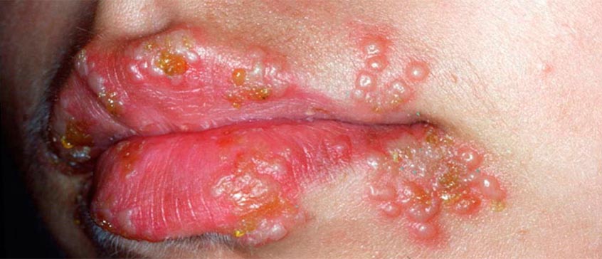 مقالة علمية بعنوان (Recurrent herpes simplex labialis ) 
