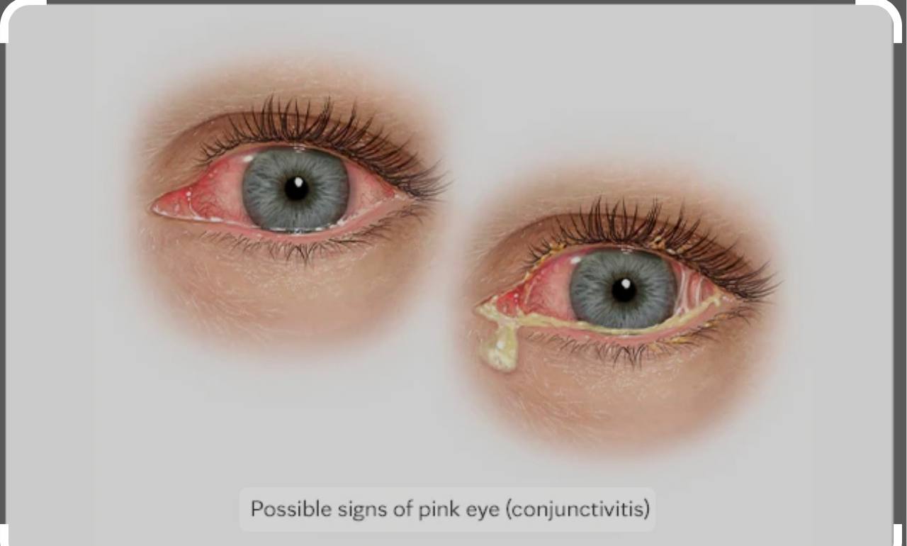 مقالة علمية للمعيدة حنين حيدر حسين بعنوان(العين القرنفلية). 