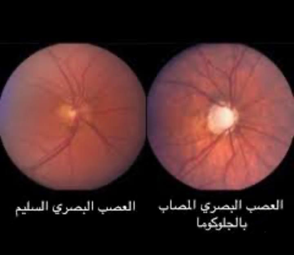 مقالة علمية للمعيدة حنين حيدر حسين بعنوان (التهاب العصب البصري).