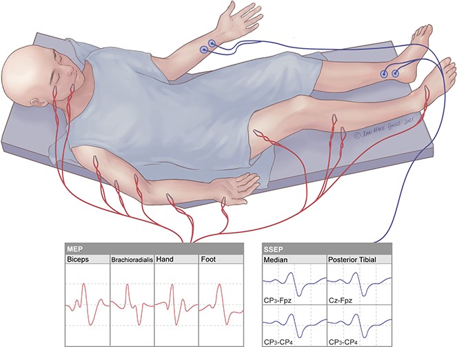 Neuro Monitoring During General Anesthesia in Surgery