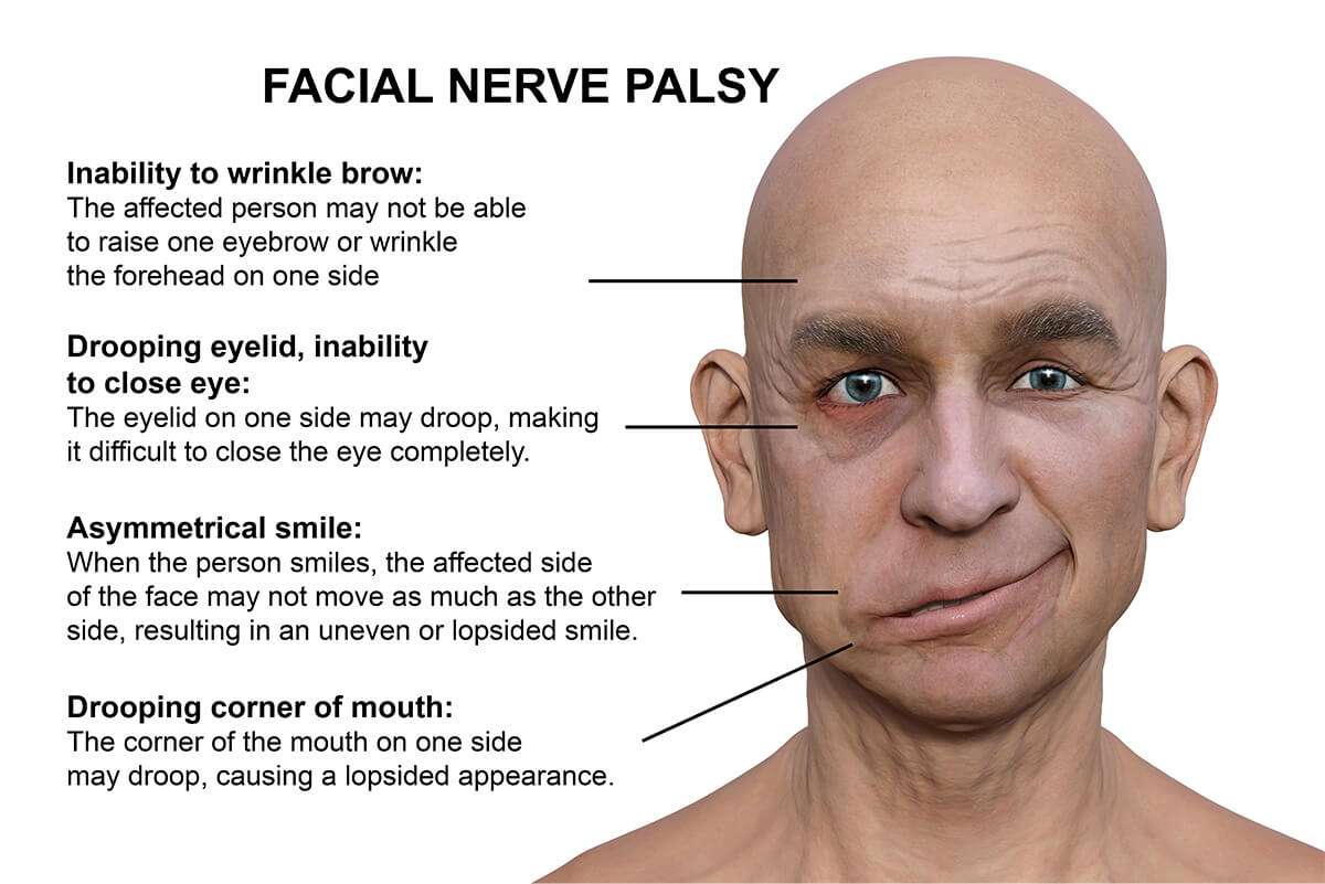 مقالة علمية بعنوان ( Facial palsy  ) 